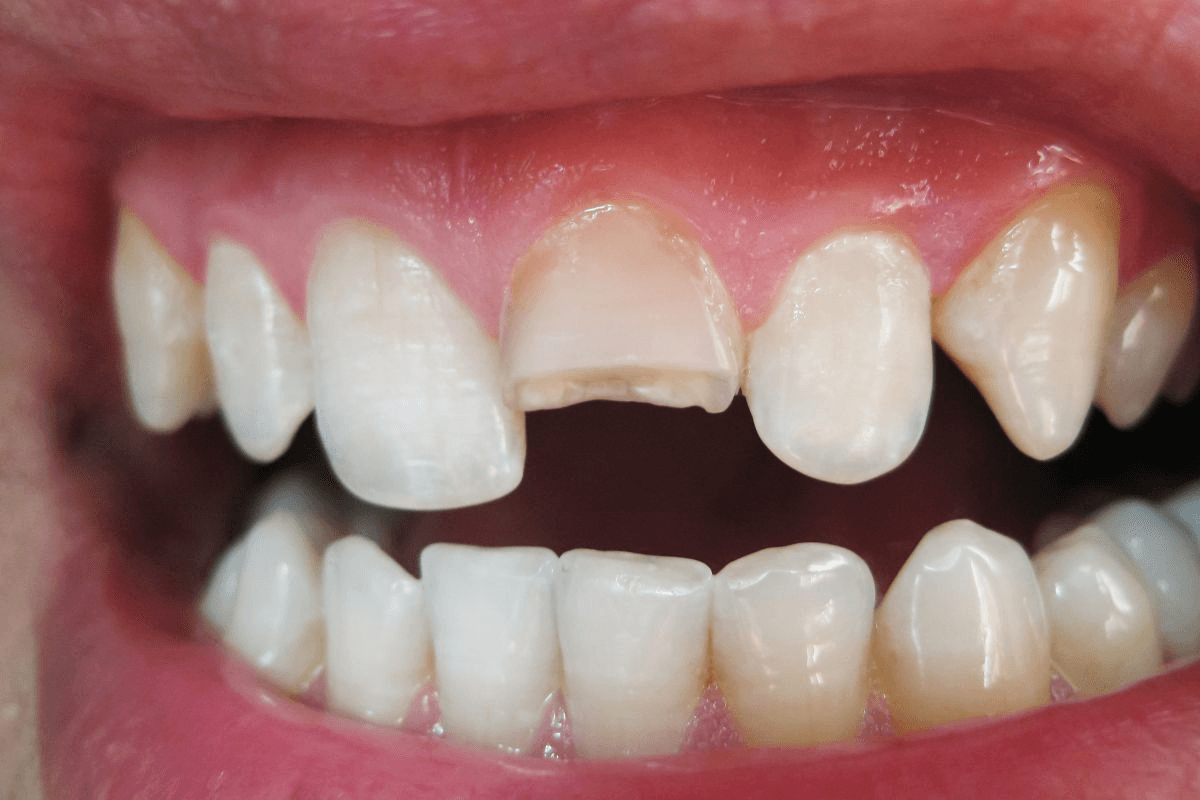 Tooth prepared for dental crown